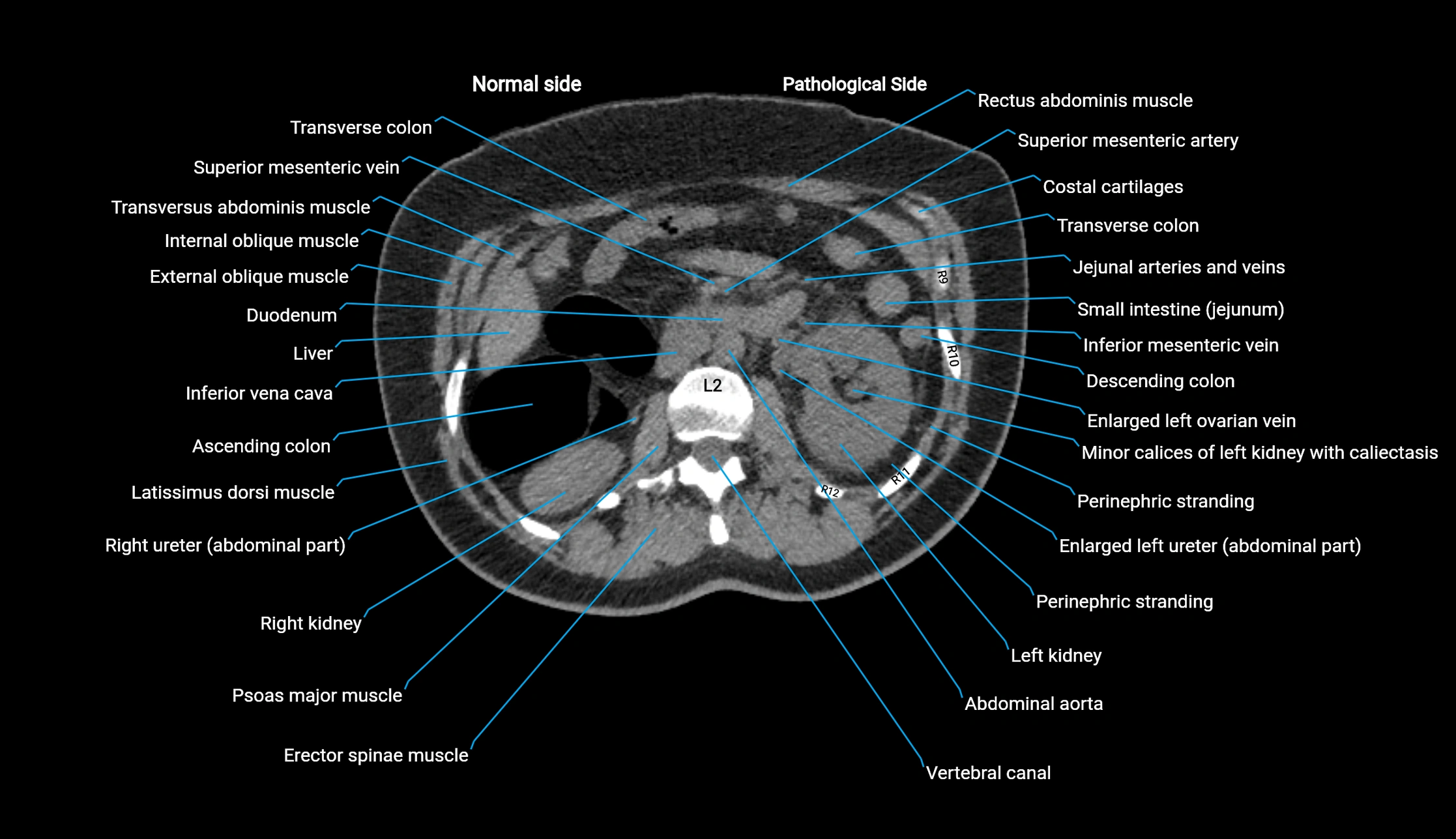 CT KUB axial cross sectional anatomy  radiology image -img-00201-00050.webp